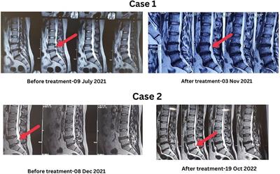 Case Report: Integrative naturopathic approach for the management of sequestered lumbar disc herniation with neurological impairments: a case series with two year follow up